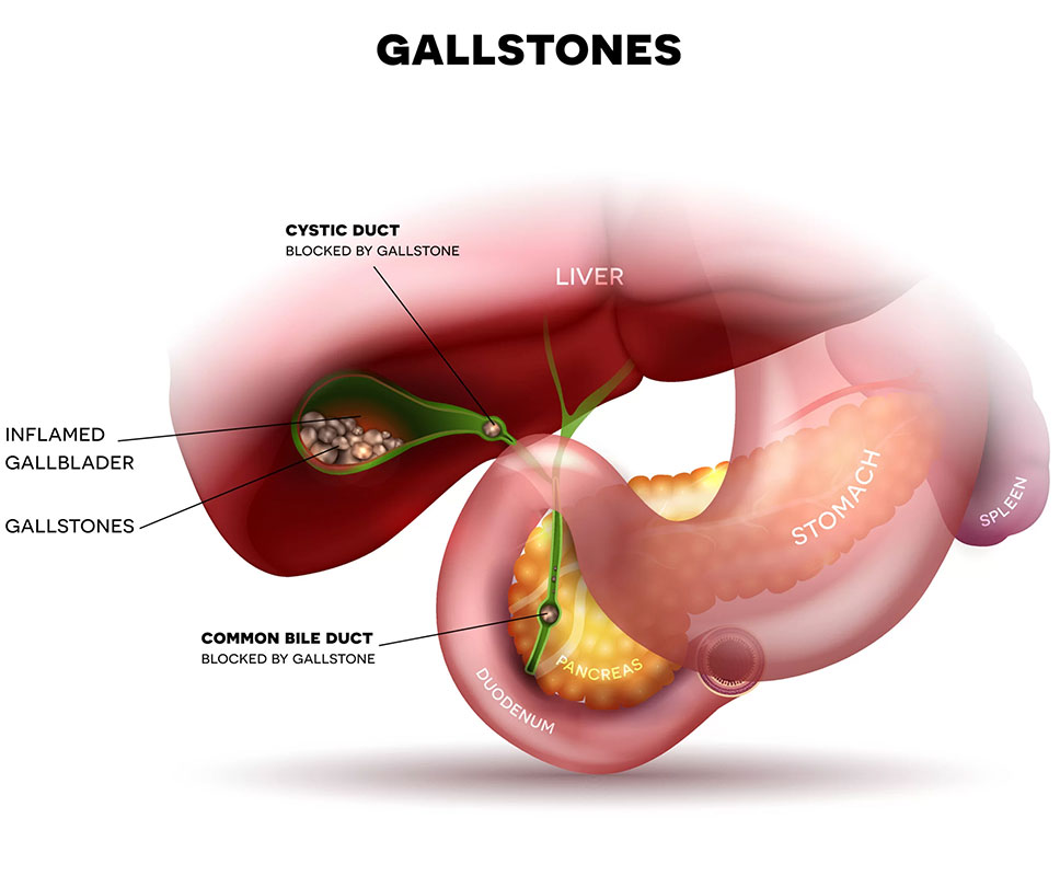 gallbladder gallstone surgery in greater Noida